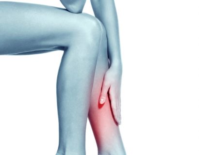 Varicose Veins