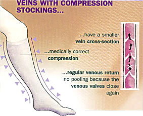 Veins with Compression Stockings | Vein Specialists of the South