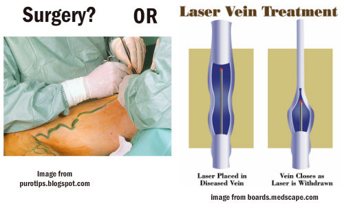 lated varicose laser