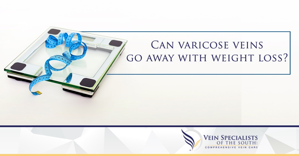 Can Losing Weight Help Varicose Veins? Vein Specialists of the South