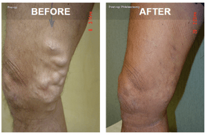varicose veins before and after photos
