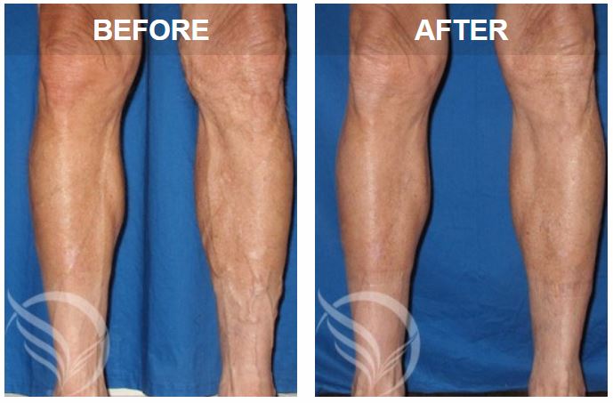 Visible Veins: When Should I Worry? - Vein Specialists Of The South | Vein Specialists Of The South