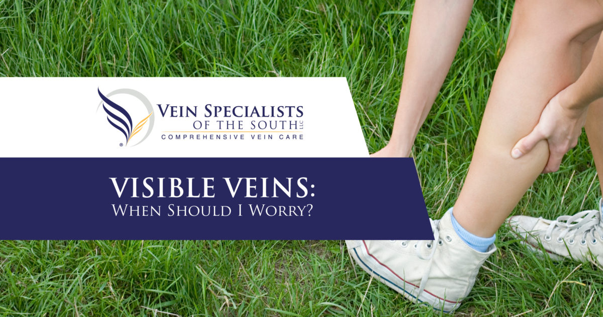 visible veins when should i worry vein specialists of the south