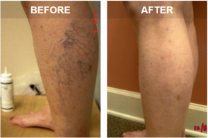 sclerotherapy procedure before and after photos