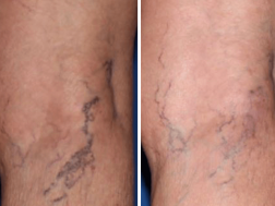 get rid of spider veins before and after photos