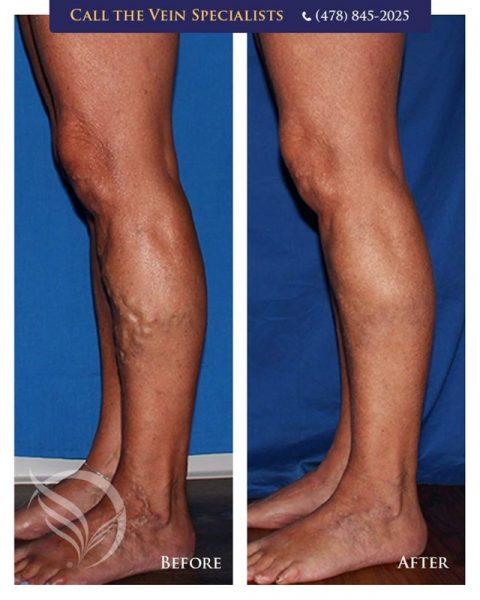 before and after varicose veins treatment