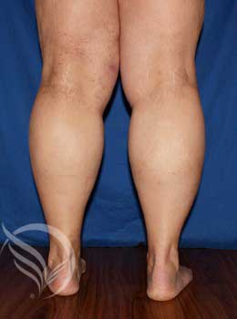 Venous Stasis Macon