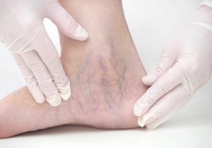 Spider Veins Macon