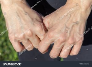 Hand Veins Macon GA