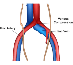 May Thurner Syndrome 2 | Vein Specialists of the South