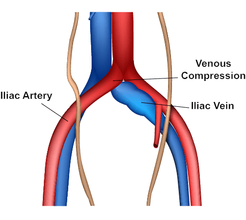 Deep Vein Thrombosis Treatment Macon