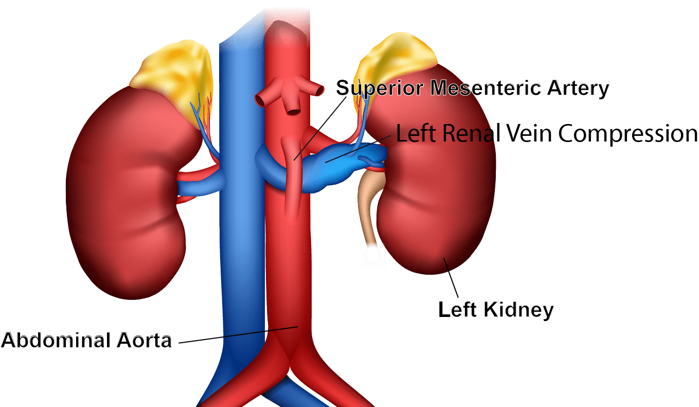 Nutcracker Syndrome Left Renal Vein At Ricardo Fletcher Blog Nutcracker Syndrome Left Renal Vein At Ricardo Fletcher Blog