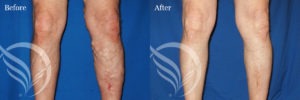 varicose veins before and after