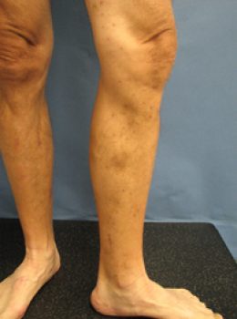 11 - After - Varicose Veins - Endovenous Closure Great Saphenous Vein & Ambulatory Phlebectomy and