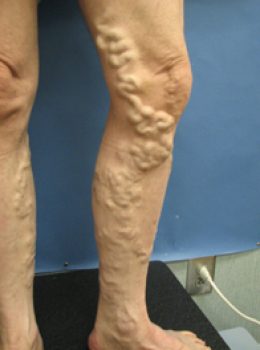 11 - Before - Varicose Veins - Endovenous Closure Great Saphenous Vein & Ambulatory Phlebectomy and