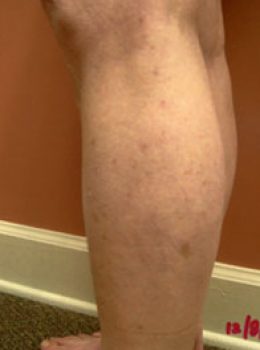 Copy of 16 - After - Varicose Veins & Spider - Min invasive Treat - Ambulatory Phlebectomy Sclerotherapy