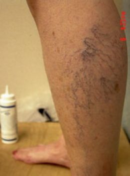 Copy of 16 - Before - Varicose Veins & Spider - Min invasive Treat - Ambulatory Phlebectomy Sclerotherapy