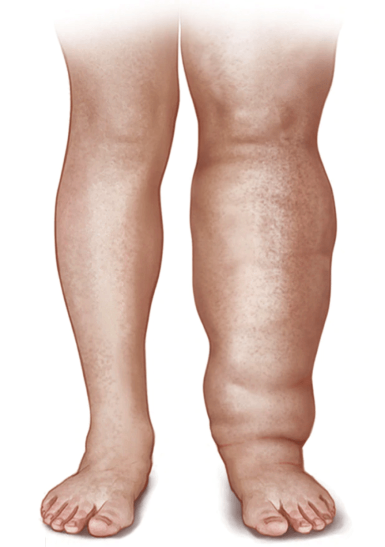 legswelling Vein Specialists of the South