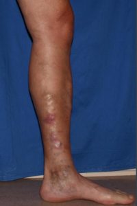 varicose veins before treatment