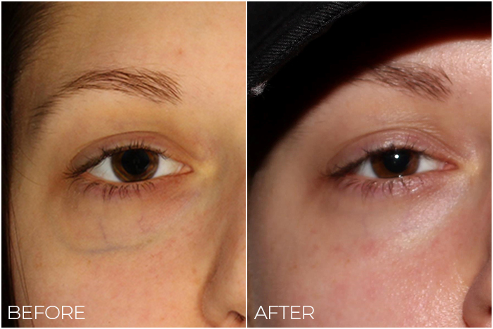 periorbital under eye veins before and after pictures