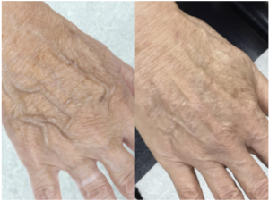 veins popping on hands before and after bulging hand veins treatment