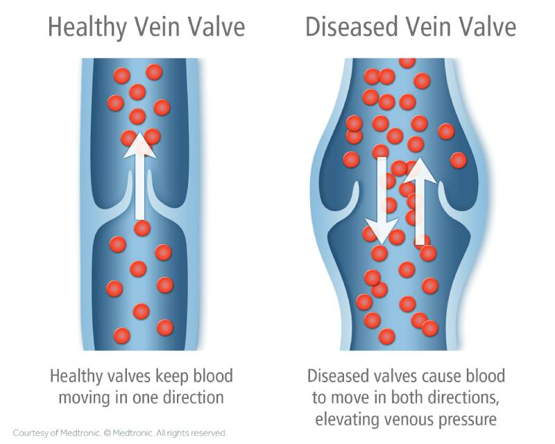 what causes varicose veins