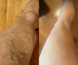 before and after varicose vein treatment in georgia