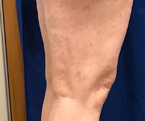 after cosmetic vein treatment georgia