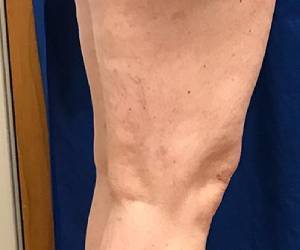 after cosmetic vein treatment georgia