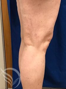 after cosmetic vein treatment for spider veins georgia