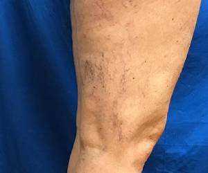 before sclerotherapy georgia