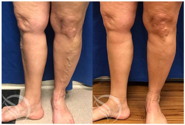 before and after varicose veins