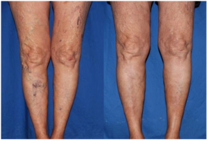 spider veins before and after photos