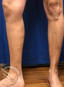 after varicose vein treatment