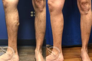 before and after varicose vein treatment georgia