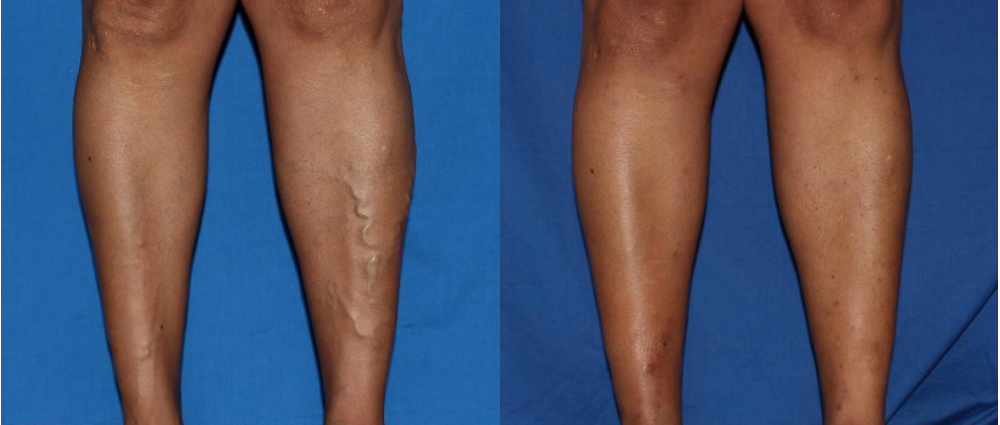 varicose veins before and after treatment at Vein Specialists of the South