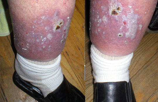 leg ulcers on swollen legs