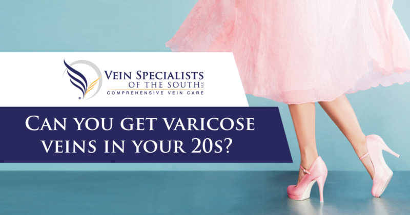 varicose veins in your 20s