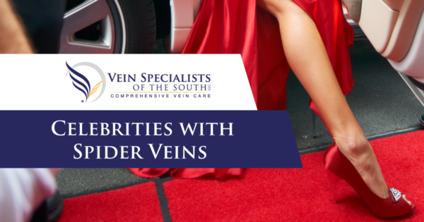 celebrities with spider veins and varicose veins