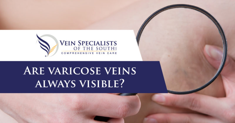 varicose veins you can't see 