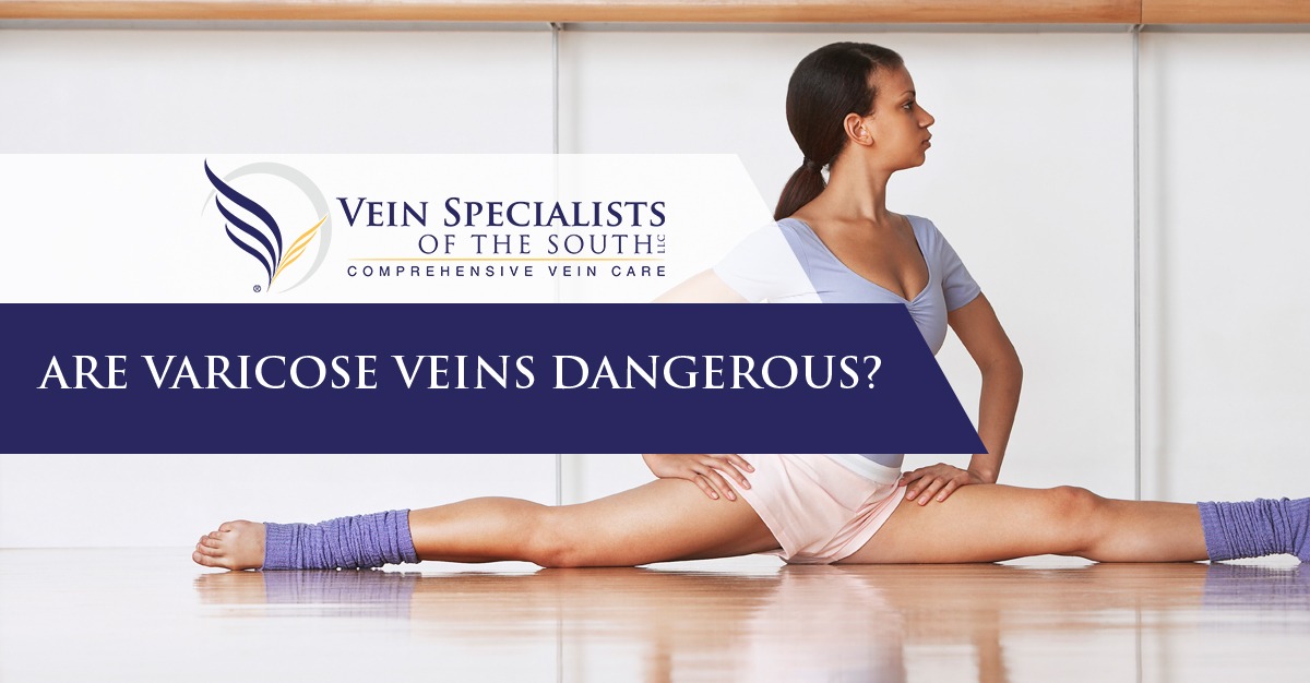 varicose veins 
