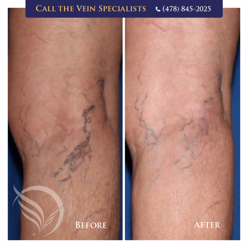 how to get rid of spider vein before and after