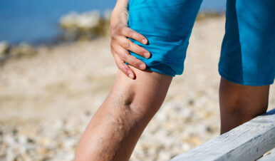 Varicose Veins Macon