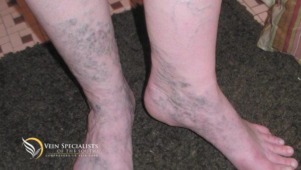 varicose veins early pregnancy symptom