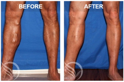 varicose veins before and after