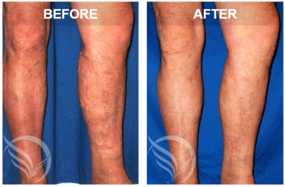 get great legs in georgia