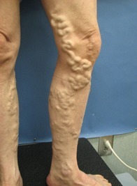 varicose veins before ambulatory phlebectomy