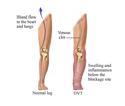 Deep Vein Thrombosis | Vein Specialists of the South