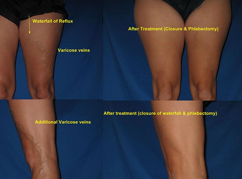 Macon GA varicose veins in pregnancy