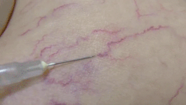 sclerotherapy procedure gif